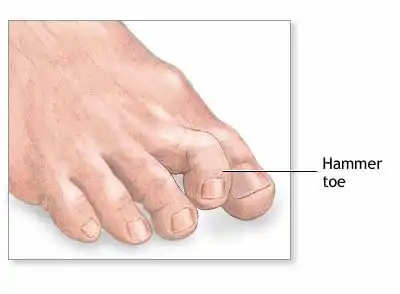 Hammer Toes