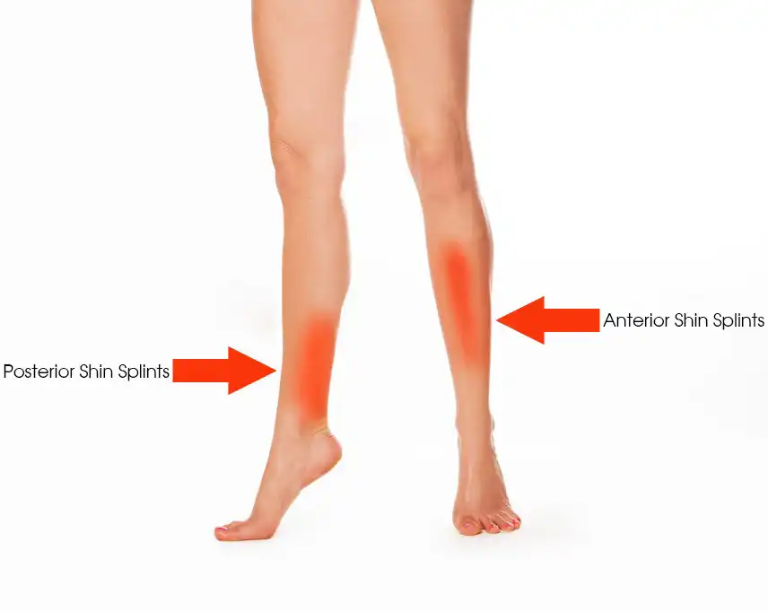Shin Splints
