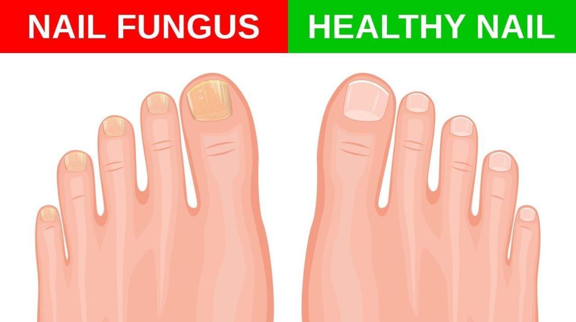 Toenail Fungal Infection and It’s Risk Factors
